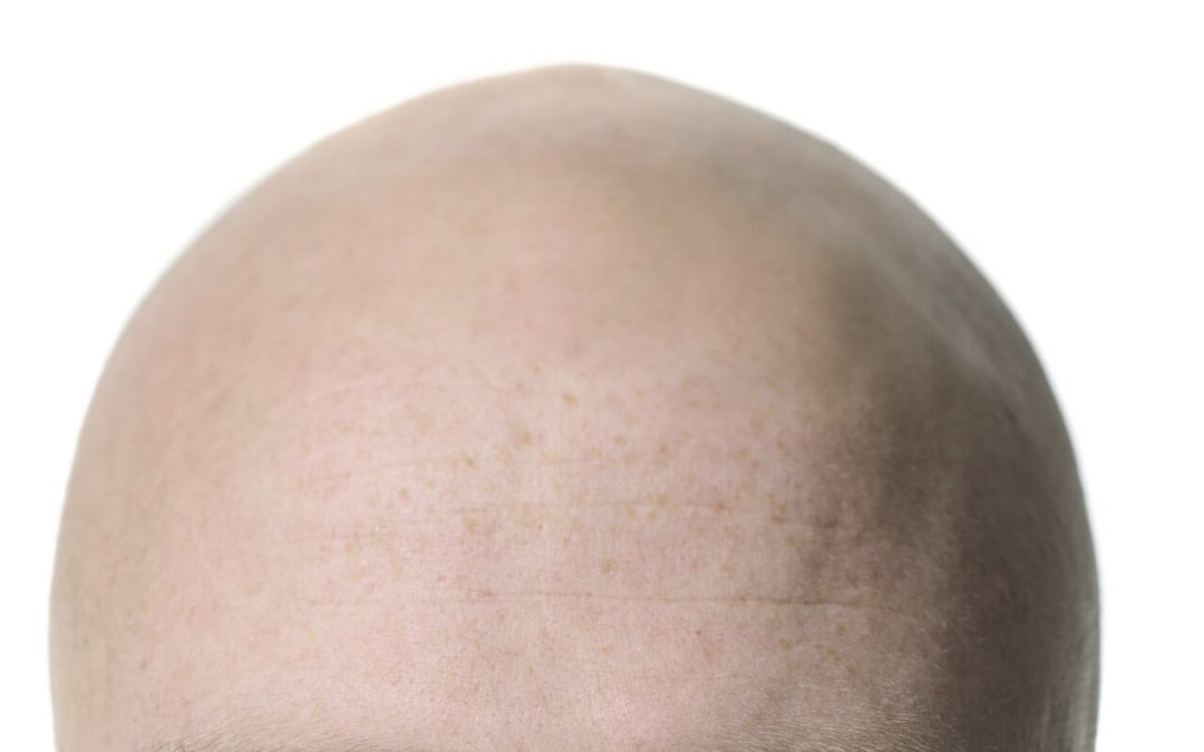 髪がないあなた